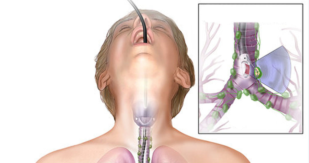 Endobronşiyal Ultrasonografi